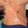 Hydrofilm plus medicazione adesiva trasparente in poliuretano 9 x 10 cm 5 pz.