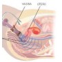 Elettrostimolatore perineale per incontinenza beac intellistim be-28ug