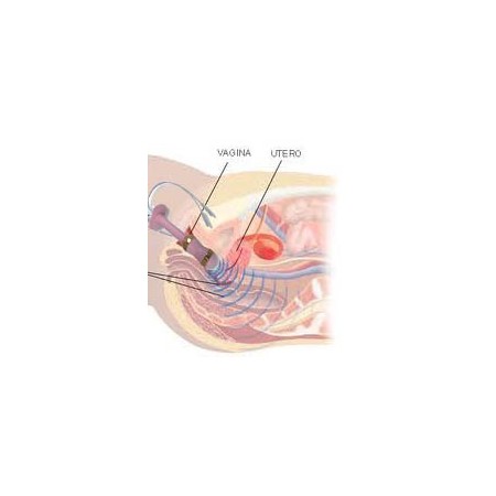 Elettrostimolatore perineale per incontinenza beac intellistim be-28ug