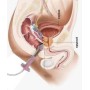 Elettrostimolatore perineale per incontinenza beac intellistim be-28ug